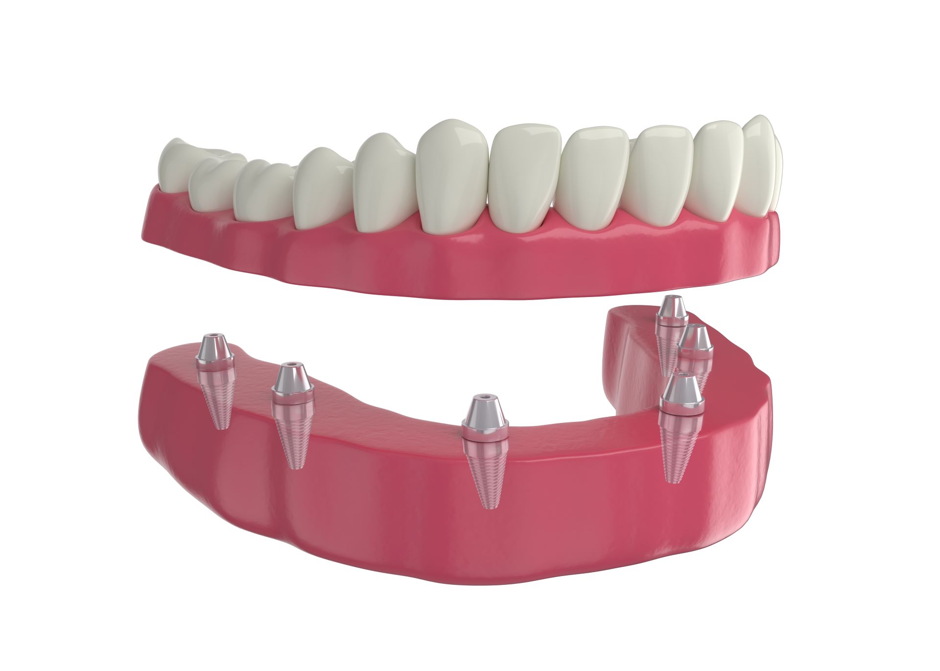 Lower Implant Dentures Do Away With Traditional Denture Frustrations